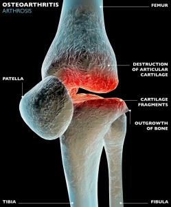 Sabinsa Ingredient Benefits Osteoarthritis According to Study